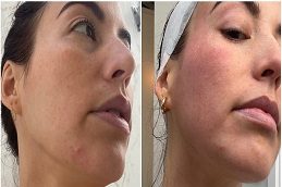 Cryotherapy Facial Before and After clinic Islamabad