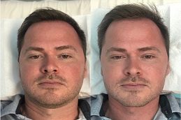 Cryotherapy Facial Before and After clinic in Islamabad