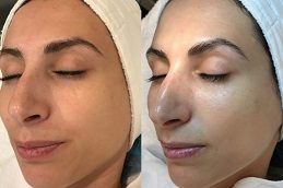 Cryotherapy Facial Before and After clinic