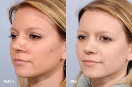 Cryotherapy Facial Before and After in Islamabad