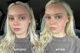 Cryotherapy Facial Before and After