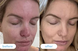 Glutathione Injection Before & After clinic in islambd