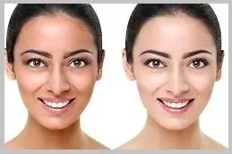 Glutathione Injection Before & After islambad