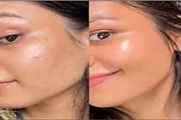 5 Billion Exosomes Price Before & After clinic islamabad