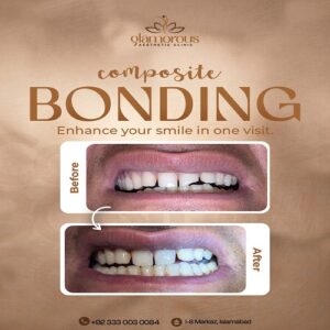 Bonding in islmabad At Glamrous Clinic