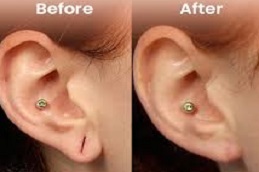 Ear Piercing Before & After Islamabad