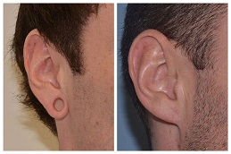 Ear Piercing Before & After clinic Islamabad