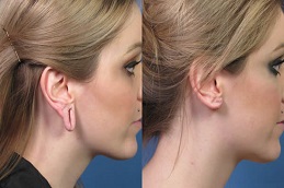 Ear Piercing Before & After in Islamabad