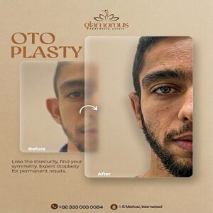Ear Reshaping Before & After Islamabad At Glamorous Clinic