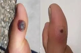 Electrocautery for Warts Removal Before & After in islamabad