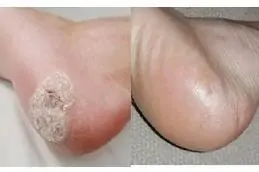 Electrocautery for Warts Removal Before & After islamabad