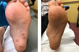 Electrocautery for Warts Removal Before & After