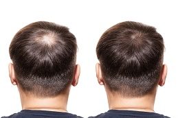 GFC Treatment for Hair Before & After Islamabad