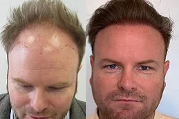 GFC Treatment for Hair Before & After Islamabad,