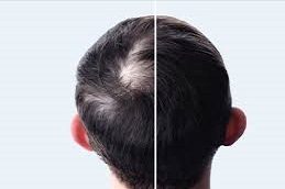 GFC Treatment for Hair Before & After clinic Islamabad,