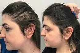 GFC Treatment for Hair Before & After clinic in Islamabad