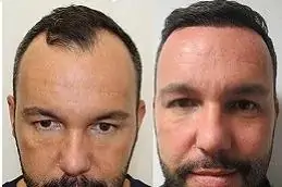 GFC Treatment for Hair Before & After clinic,