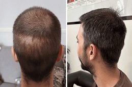 GFC Treatment for Hair Before & After