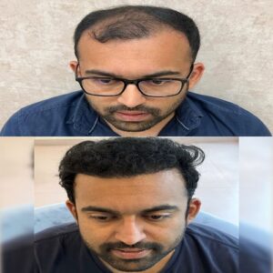 Hair Transplant Before & After Islamabad At Glamorous Clinic