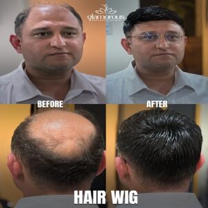 Hair Waige Before & After Islamabad At Glamorous Clinic,