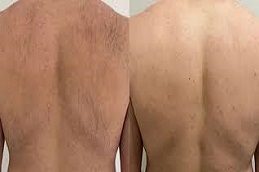 Laser Hair Removal For Back Area Before & After in islamabad