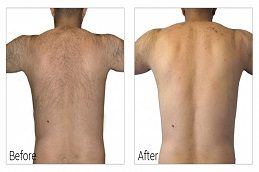 Laser Hair Removal For Back Area Before & After islamabad