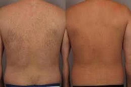 Laser Hair Removal For Back Area Before & After