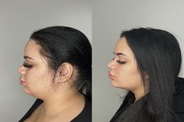 Lemon Bottle Fat Dissolving Before & After Islamabad