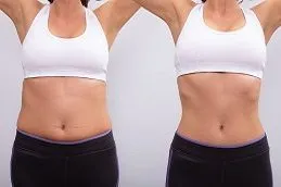 lemon bottle fat dissolving injection recent incidents pakistan Lemon Bottle Fat Dissolving in Islamabad Pakistan