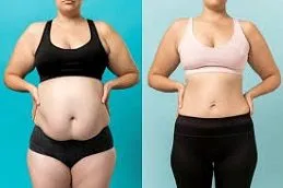 lemon bottle fat dissolving injection recent incidents pakistan Lemon Bottle Fat Dissolving in Islamabad Pakistan