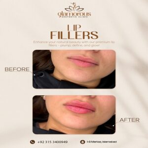 Lip Fillers Before & After Islamabad At Glamorous Clinic