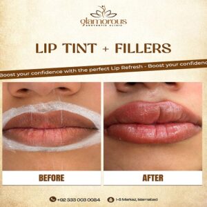 Lip Tient Filler Islambad At Glamrous Clinic