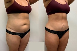 Lipo 360 Liposuction Before & After Islamabad,