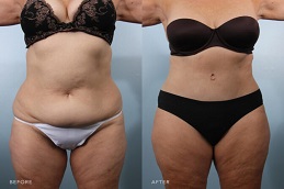 Lipo 360 Liposuction Before & After Islamabad