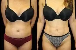 Lipo 360 Liposuction Before & After Islamabad,