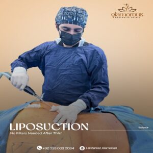 Liposuction Before & After Islamabad At Glamorous Clinic.