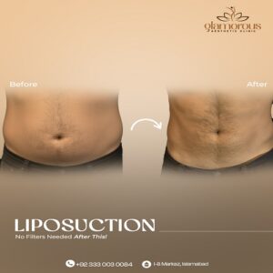 Liposuction Before & After Islamabad At Glamorous Clinic