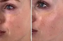 Result Kiara Reju PDRN Skin Booster Islamabad