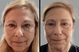 Result Kiara Reju PDRN Skin Booster in Islamabad.