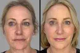 Result Kiara Reju PDRN Skin Booster in Islamabad,