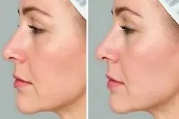 Result Kiara Reju PDRN Skin Booster in Islamabad