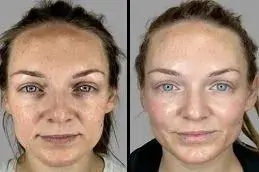 Result Kiara Reju PDRN Skin Booster