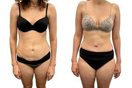 Result of Tummy Tuck Islamabad
