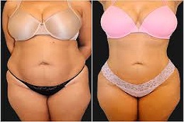 Results OF 360 Liposuction clinic in Islamabad