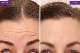 Results OF Botox For Frown Lines Islamabad,