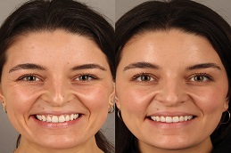 Results OF Botox For Frown Lines Islamabad