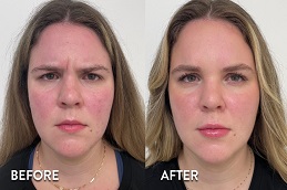 Results OF Botox For Frown Lines in Islamabad