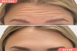 Results OF Botox For Frown Lines in clinic Islamabad