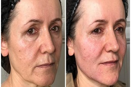 Results OF Botox For Frown Lines