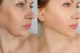 Results OF Botox for Crow’s Feet Islamabad Pakistan,